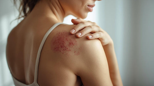 Best Natural Eczema Treatments & Why Tallow Actually Works